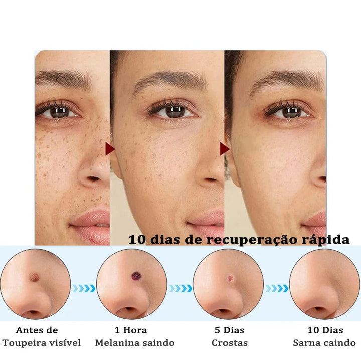 Caneta Plasma Elétrica 19 Níveis – Remove Verrugas e Manchas em Casa